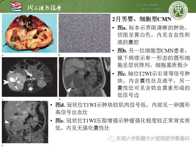 【PPT】儿童肾肿瘤：影像-病理相关性第一部分(0 ~ 10岁)