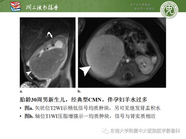 【PPT】儿童肾肿瘤：影像-病理相关性第一部分(0 ~ 10岁)