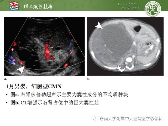 【PPT】儿童肾肿瘤：影像-病理相关性第一部分(0 ~ 10岁)
