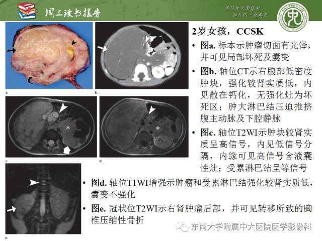 【PPT】儿童肾肿瘤：影像-病理相关性第一部分(0 ~ 10岁)