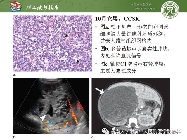【PPT】儿童肾肿瘤：影像-病理相关性第一部分(0 ~ 10岁)
