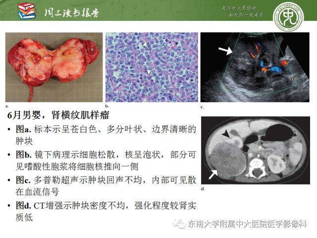 【PPT】儿童肾肿瘤：影像-病理相关性第一部分(0 ~ 10岁)