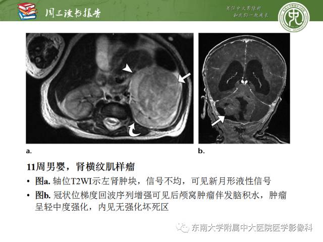 【PPT】儿童肾肿瘤：影像-病理相关性第一部分(0 ~ 10岁)
