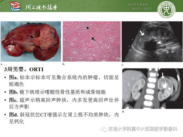【PPT】儿童肾肿瘤：影像-病理相关性第一部分(0 ~ 10岁)
