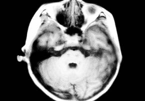 【病例】肾上腺脑白质营养不良1例MR影像表现 【病例】肾上腺脑白质营养不良1例MR影像表现