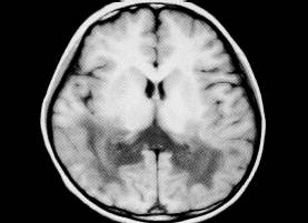 【病例】肾上腺脑白质营养不良1例MR影像表现 【病例】肾上腺脑白质营养不良1例MR影像表现