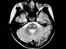 【病例】肾上腺脑白质营养不良1例MR影像表现 【病例】肾上腺脑白质营养不良1例MR影像表现