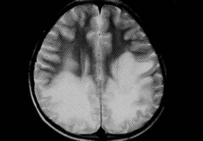 【病例】肾上腺脑白质营养不良1例MR影像表现 【病例】肾上腺脑白质营养不良1例MR影像表现