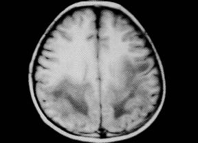 【病例】肾上腺脑白质营养不良1例MR影像表现 【病例】肾上腺脑白质营养不良1例MR影像表现