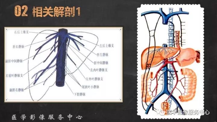 【PPT】布加综合征