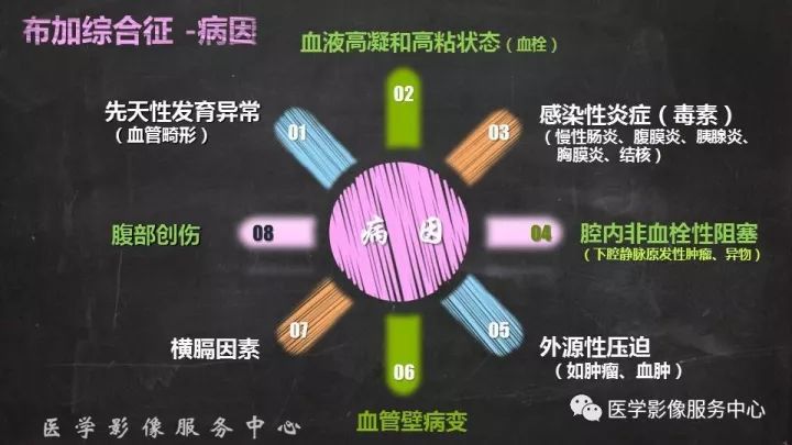 【PPT】布加综合征