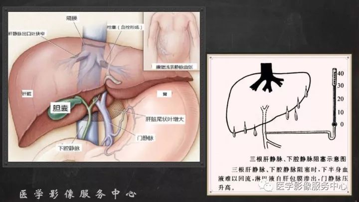 【PPT】布加综合征