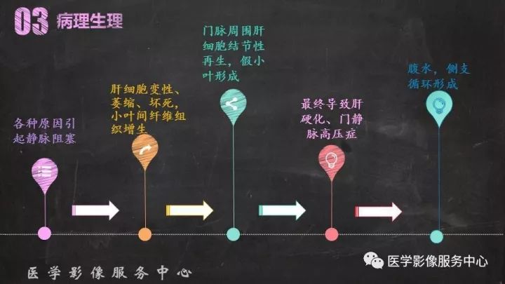 【PPT】布加综合征