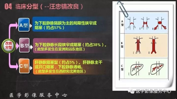 【PPT】布加综合征