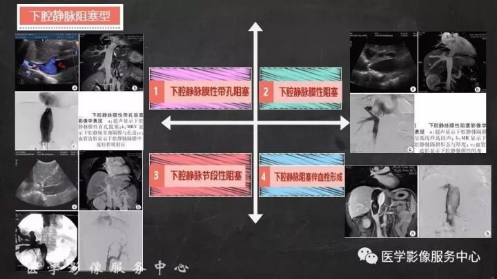 【PPT】布加综合征