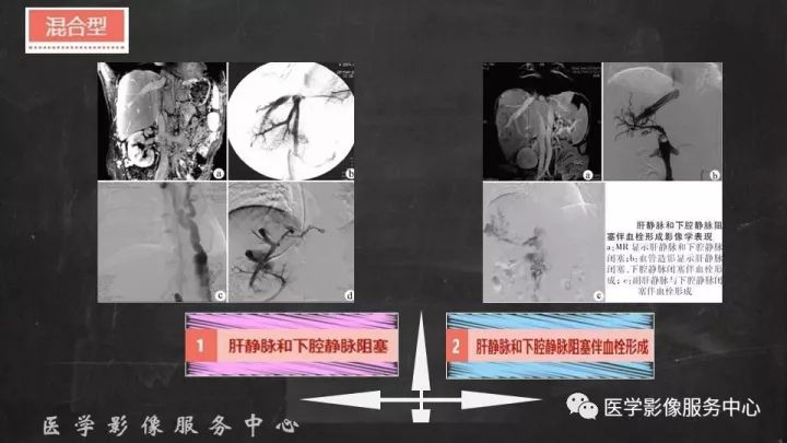 【PPT】布加综合征