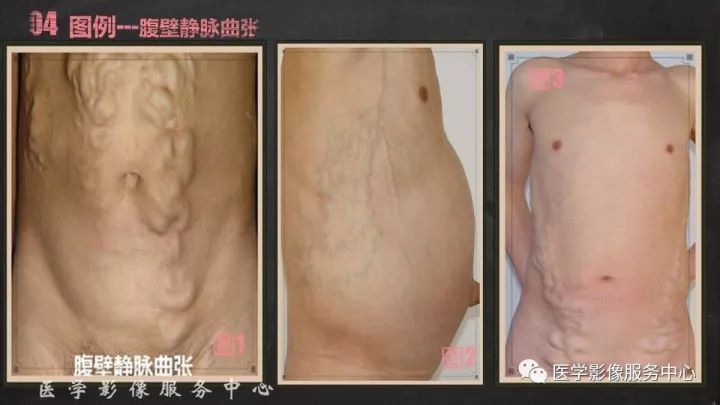 【PPT】布加综合征