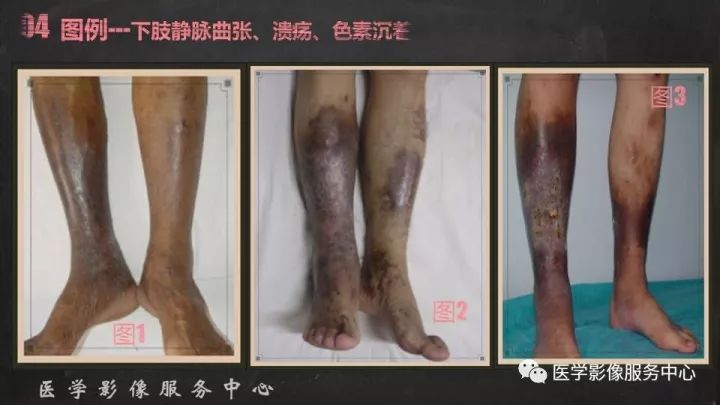 【PPT】布加综合征