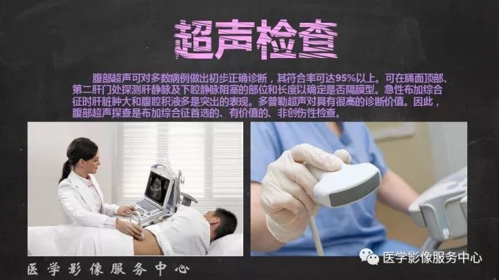 【PPT】布加综合征