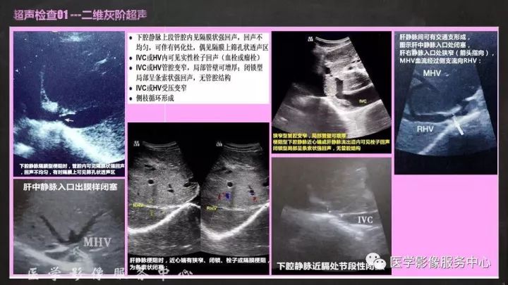 【PPT】布加综合征