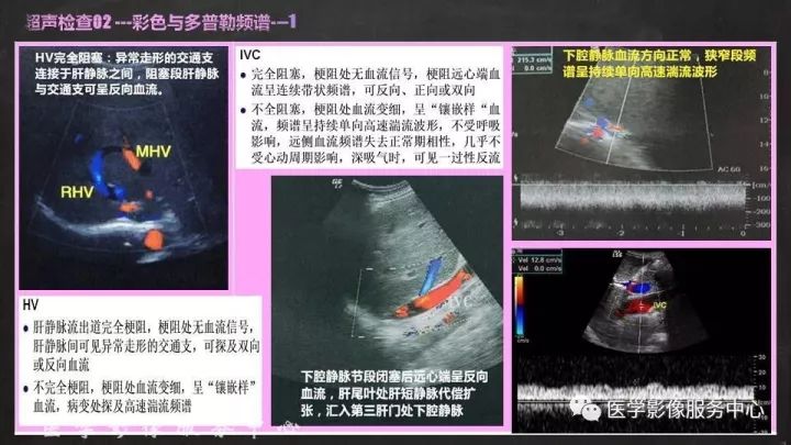 【PPT】布加综合征