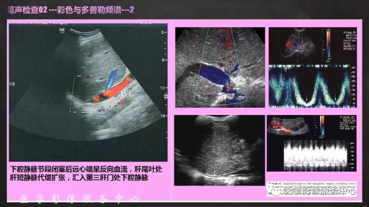 【PPT】布加综合征