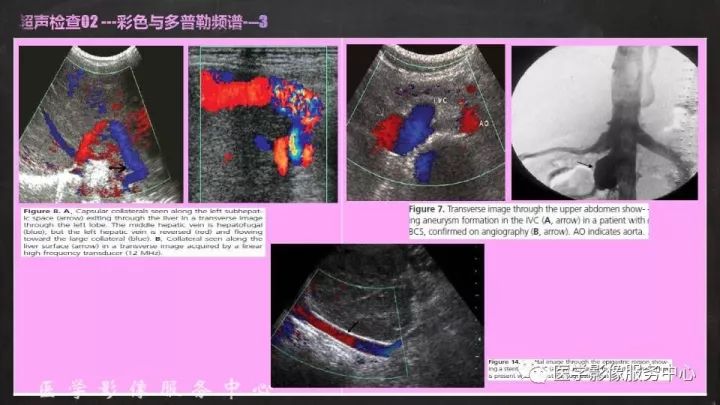 【PPT】布加综合征