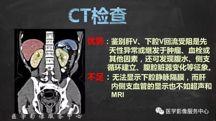 【PPT】布加综合征