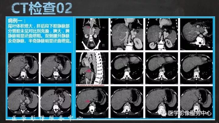 【PPT】布加综合征