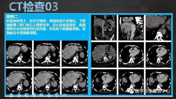【PPT】布加综合征