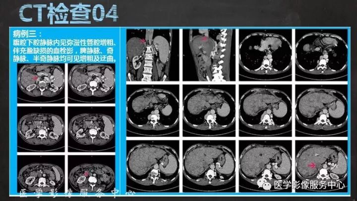 【PPT】布加综合征