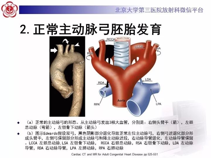 【病例】右位主动脉弓合并迷走左锁骨下动脉1例CT