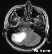 【病例】血管母细胞瘤1例MR 【病例】血管母细胞瘤1例MR