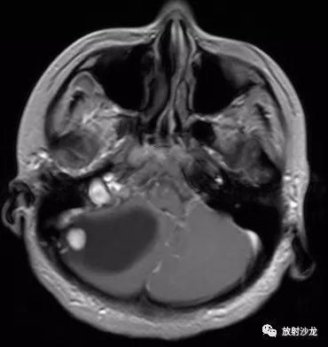 【病例】血管母细胞瘤1例MR