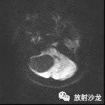 【病例】血管母细胞瘤1例MR 【病例】血管母细胞瘤1例MR