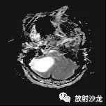 【病例】血管母细胞瘤1例MR 【病例】血管母细胞瘤1例MR