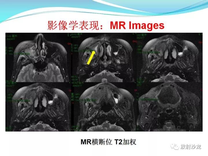 【病例】上颌窦低度恶性纤维组织细胞瘤1例MR
