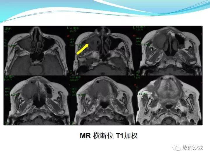 【病例】上颌窦低度恶性纤维组织细胞瘤1例MR