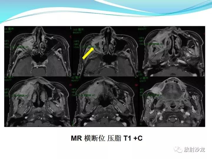 【病例】上颌窦低度恶性纤维组织细胞瘤1例MR