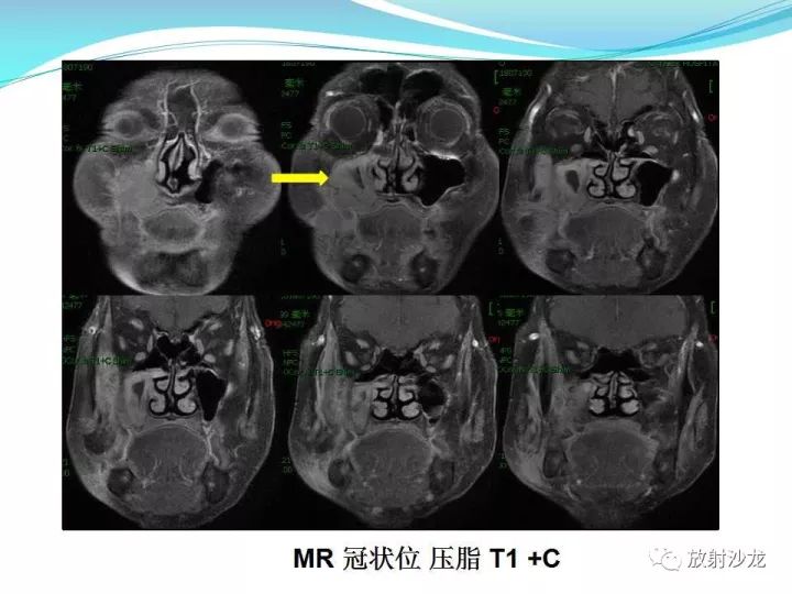 【病例】上颌窦低度恶性纤维组织细胞瘤1例MR