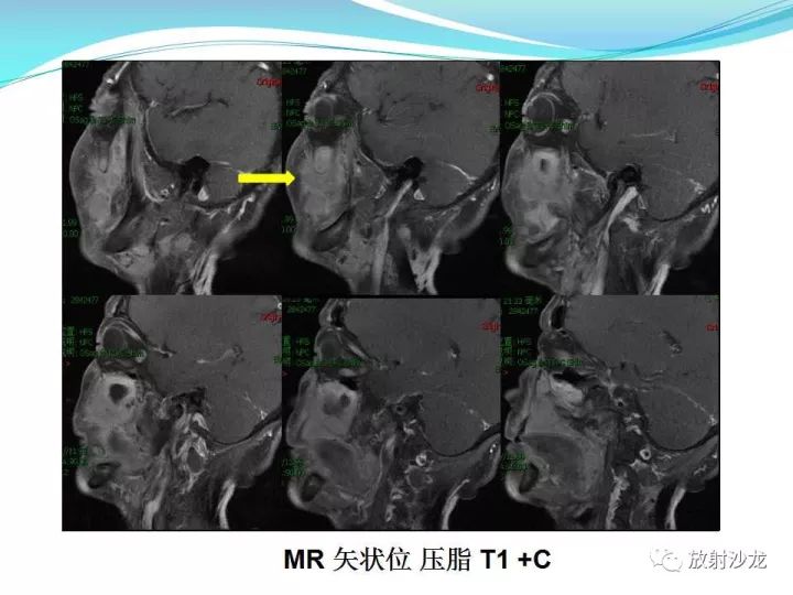 【病例】上颌窦低度恶性纤维组织细胞瘤1例MR