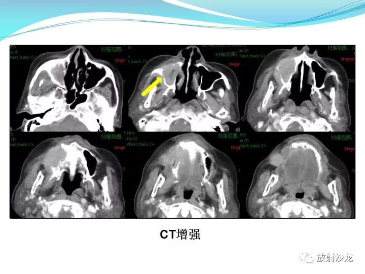 【病例】上颌窦低度恶性纤维组织细胞瘤1例MR