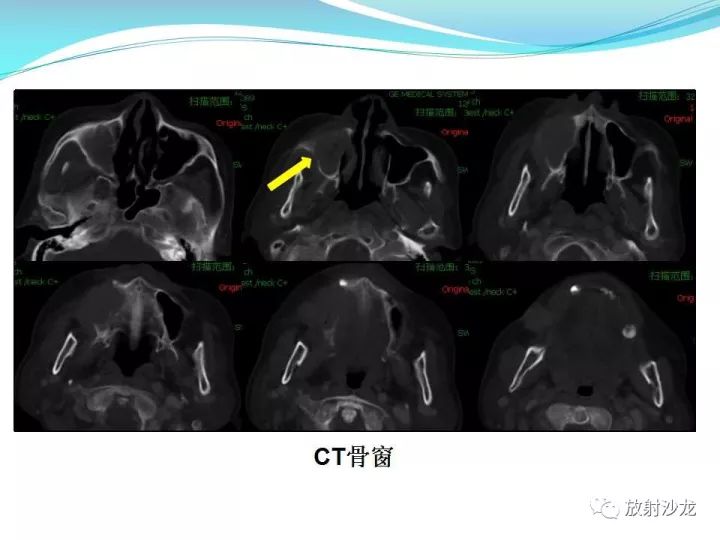 【病例】上颌窦低度恶性纤维组织细胞瘤1例MR