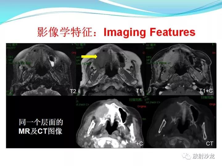 【病例】上颌窦低度恶性纤维组织细胞瘤1例MR
