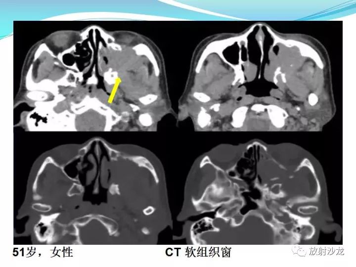 【病例】上颌窦低度恶性纤维组织细胞瘤1例MR