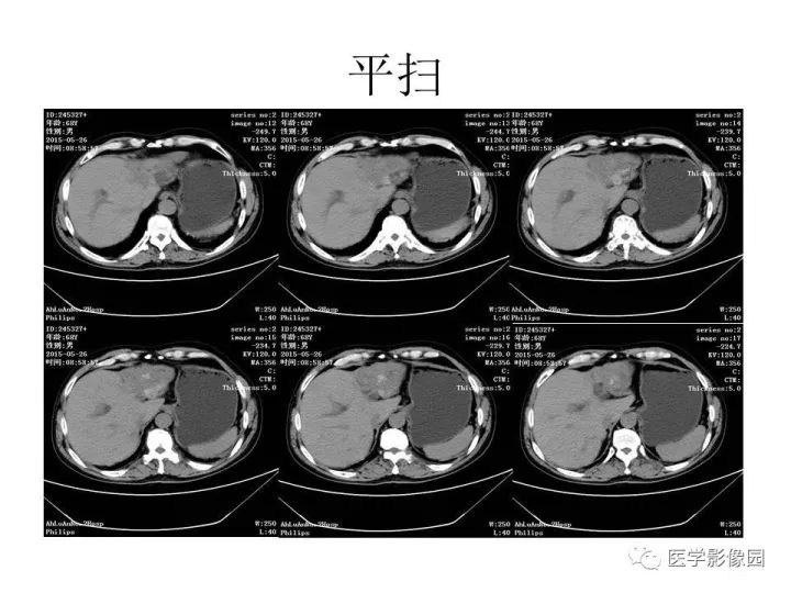 【病例】肝内胆管细胞癌1例CT影像表现
