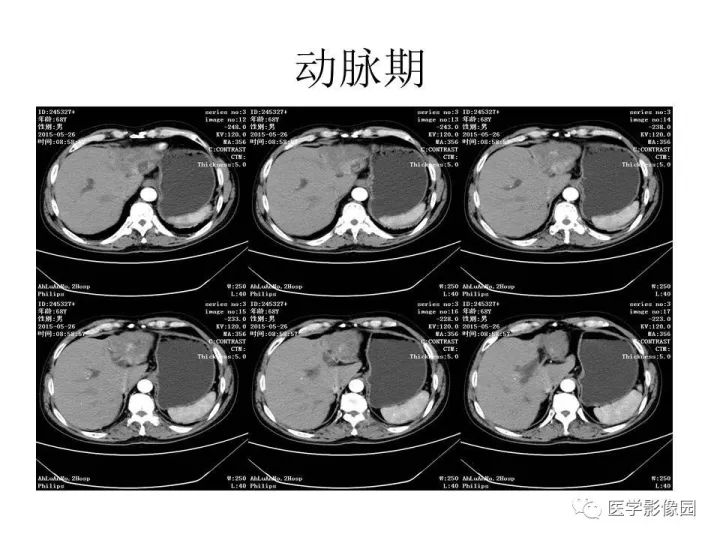 【病例】肝内胆管细胞癌1例CT影像表现