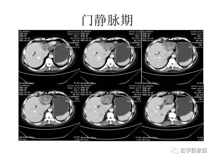 【病例】肝内胆管细胞癌1例CT影像表现
