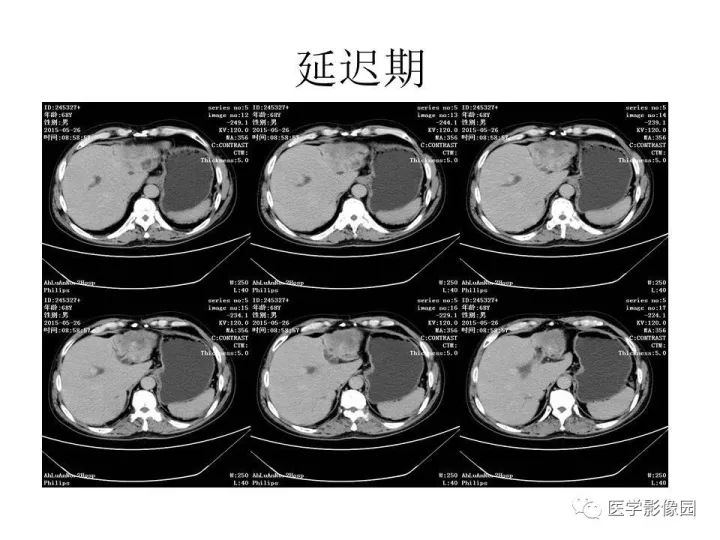 【病例】肝内胆管细胞癌1例CT影像表现
