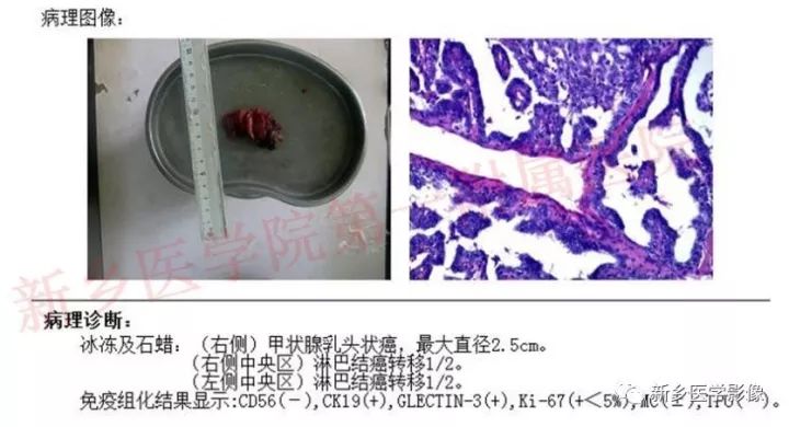 【病例】甲状腺乳头状癌1例CT影像表现 【病例】甲状腺乳头状癌1例CT影像表现